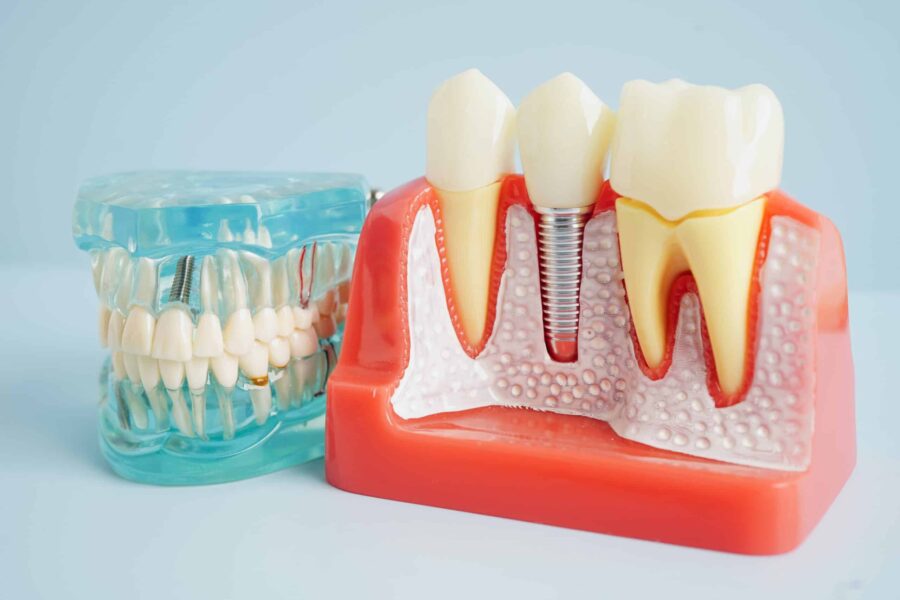 Dental Implants san francisco